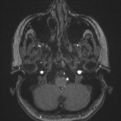 A1 segment hypoplasia (Radiopaedia 83365-97781 Axial TOF MRA 10).jpg
