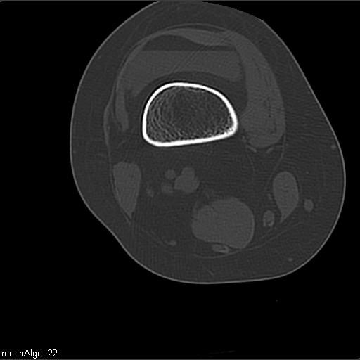 File:ACL avulsion fracture (Radiopaedia 33833-34994 Axial bone window 7).jpg