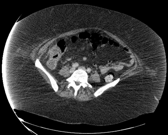 File:Abdominal abscess - pre and post percutaneous drainage (Radiopaedia 60209-67816 Axial 54).png