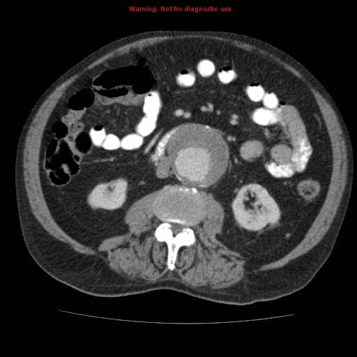 Abdominal aortic aneurysm (Radiopaedia 10122-10660 Axial C+ portal venous phase 39).jpg