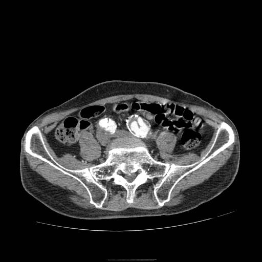 File:Abdominal aortic aneurysm (Radiopaedia 13341-13340 Axial C+ arterial phase 169).jpg