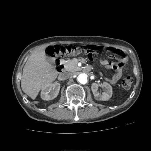File:Abdominal aortic aneurysm (Radiopaedia 13341-13340 Axial C+ arterial phase 69).jpg