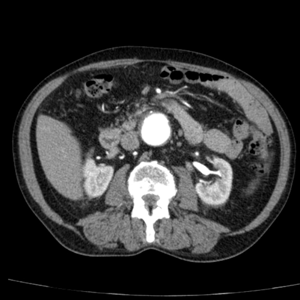 Abdominal aortic aneurysm (Radiopaedia 29248-29660 Axial C+ arterial phase 37).jpg