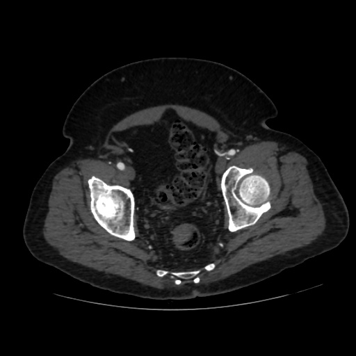 File:Abdominal aortic aneurysm (Radiopaedia 57318-64259 Axial C+ arterial phase 68).jpg