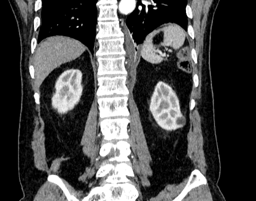 Abdominal aortic aneurysm (Radiopaedia 67117-76452 Coronal C+ arterial phase 79).jpg