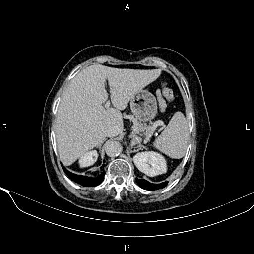 Abdominal aortic aneurysm (Radiopaedia 85063-100606 Axial C+ delayed 10).jpg