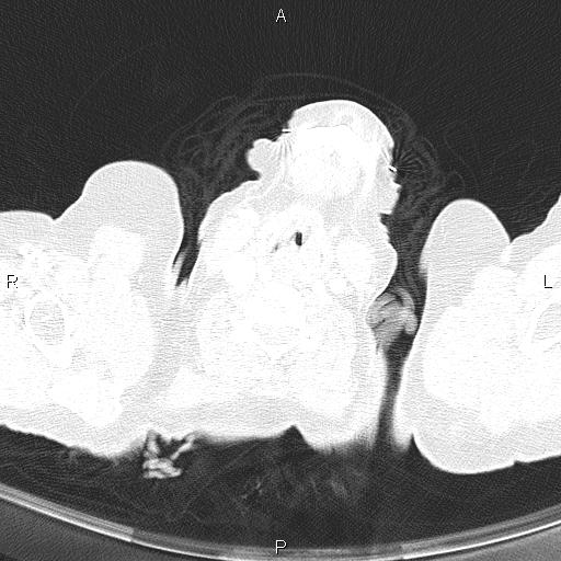 Abdominal aortic aneurysm (Radiopaedia 85063-100606 Axial lung window 1).jpg