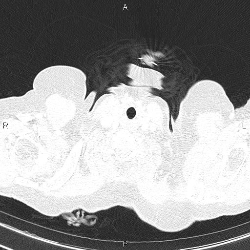 File:Abdominal aortic aneurysm (Radiopaedia 85063-100606 Axial lung window 4).jpg