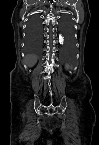 Abdominal aortic aneurysm with thrombus fissuration (Radiopaedia 73192-83919 Coronal C+ arterial phase 78).jpg