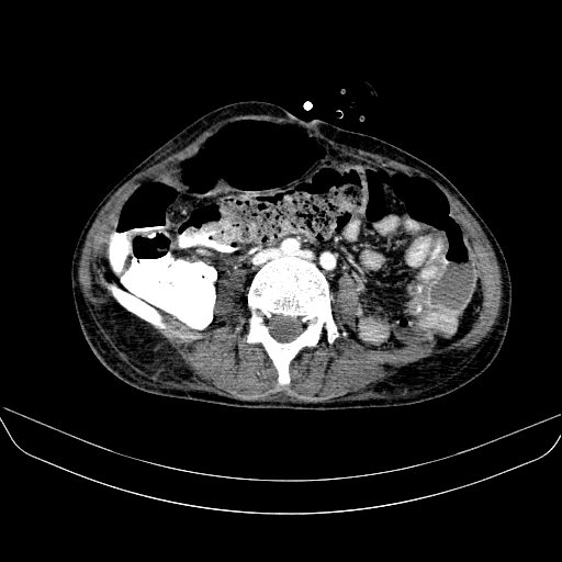 File:Abdominal collection due to previous cecal perforation (Radiopaedia 80831-94320 Axial C+ portal venous phase 121).jpg