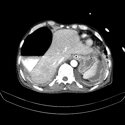 File:Abdominal collection due to previous cecal perforation (Radiopaedia 80831-94320 Axial C+ portal venous phase 29).jpg