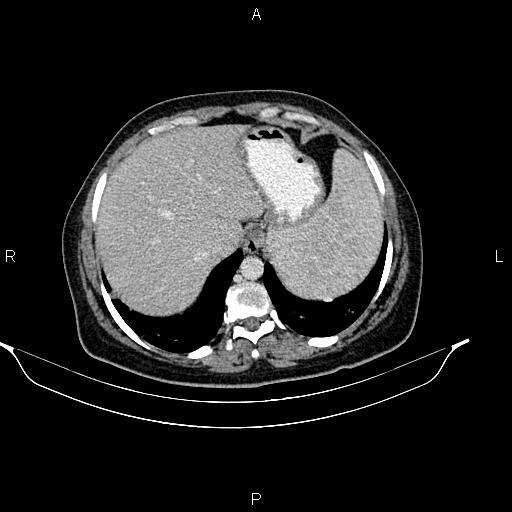 Abdominal lymphoma with sandwich sign (Radiopaedia 84378-99704 Axial C+ portal venous phase 9).jpg