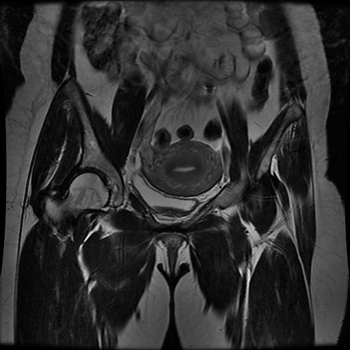 File:Abdominal wall endometriosis (Radiopaedia 83702-98847 Coronal T2 6).jpg