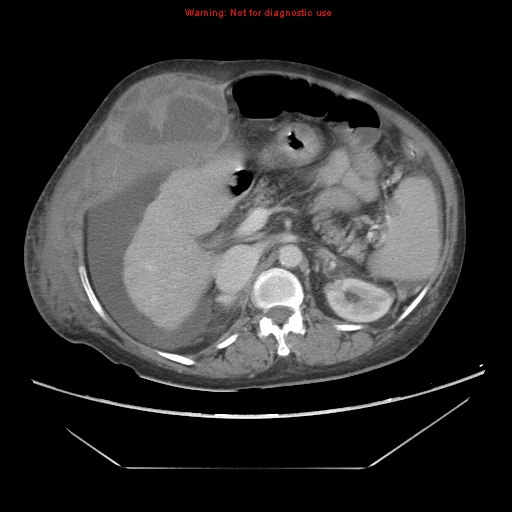 File:Abdominal wall hematoma (Radiopaedia 9427-10112 Axial C+ portal venous phase 37).jpg