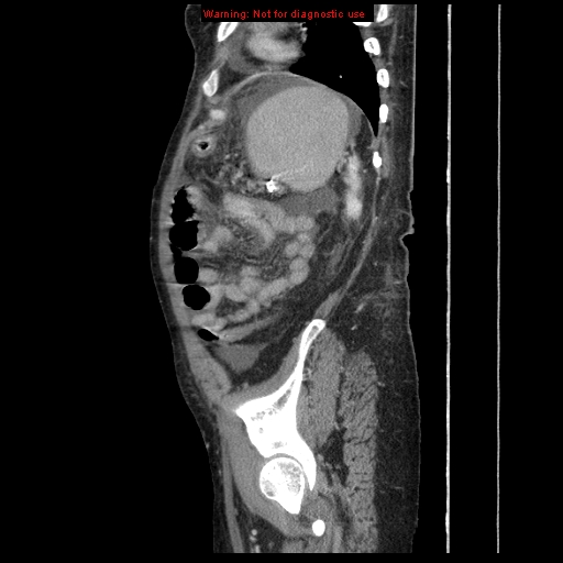 Abdominal wall hematoma (Radiopaedia 9427-10112 Sagittal C+ portal venous phase 23).jpg