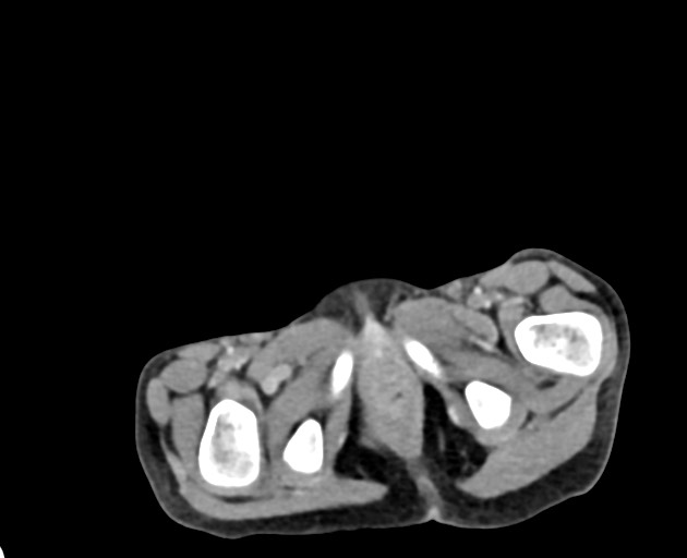 Abdominopelvic rhabdomyosarcoma (Radiopaedia 78356-90984 Axial C+ portal venous phase 158).jpg