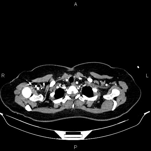 Aberrant right subclavian artery (Radiopaedia 87334-103629 Axial C+ arterial phase 9).jpg