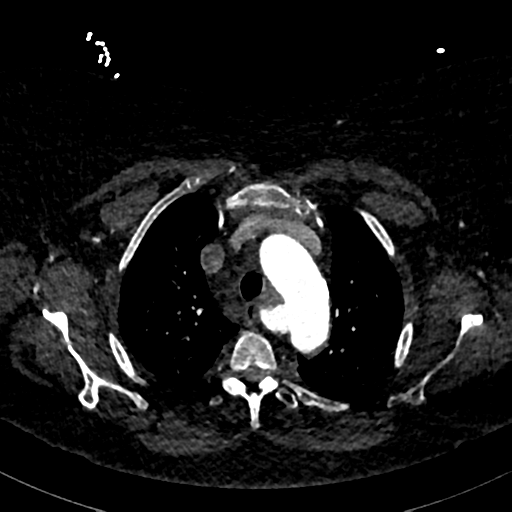 Aberrant right subclavian artery with Kommerell diverticulum (Radiopaedia 47982-52769 Axial C+ arterial phase 24).png