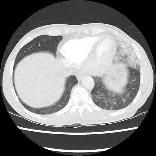 Accessory left horizontal fissure with lingular pneumonia (Radiopaedia 53763-59843 Axial lung window 44).jpg