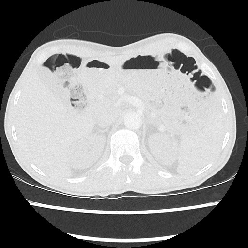 Accessory left horizontal fissure with lingular pneumonia (Radiopaedia 53763-59843 Axial lung window 56).jpg