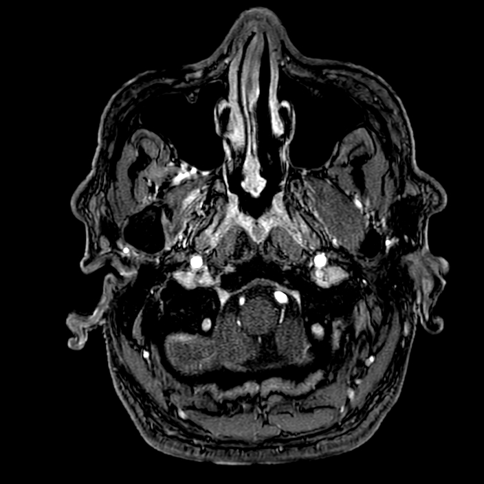 Accessory middle cerebral artery (Radiopaedia 73114-83828 Axial MRA 5).jpg