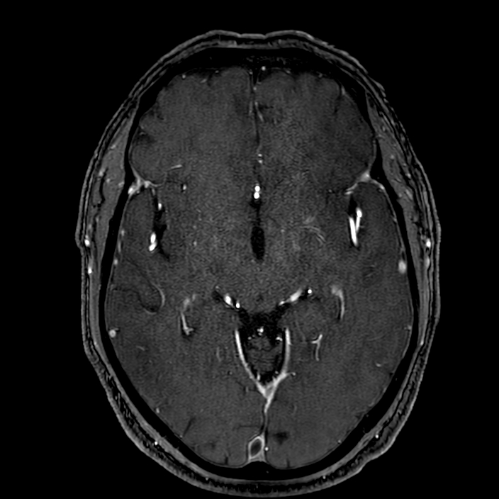 Accessory middle cerebral artery (Radiopaedia 73114-83828 Axial MRA 88).jpg