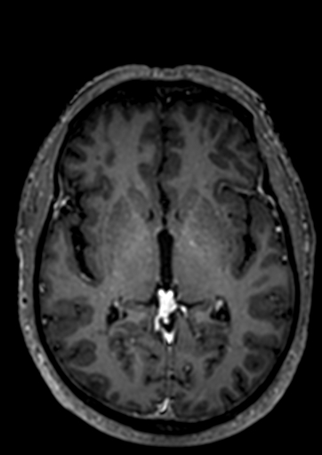 Accessory middle cerebral artery (Radiopaedia 73114-83828 Axial T1 C+ 34).jpg