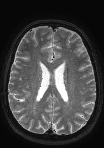 Accessory middle cerebral artery (Radiopaedia 73114-83828 Axial T2 25).jpg