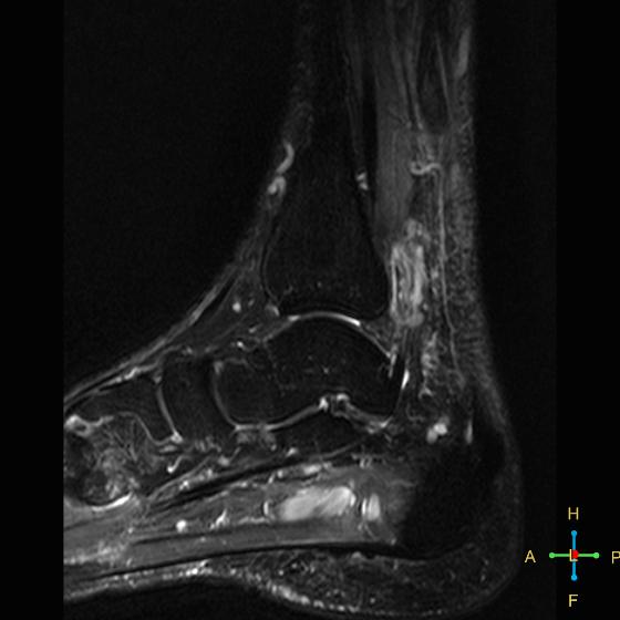 File:Achilles tendon complete tear (Radiopaedia 22834-22854 Sagittal STIR 12).jpg