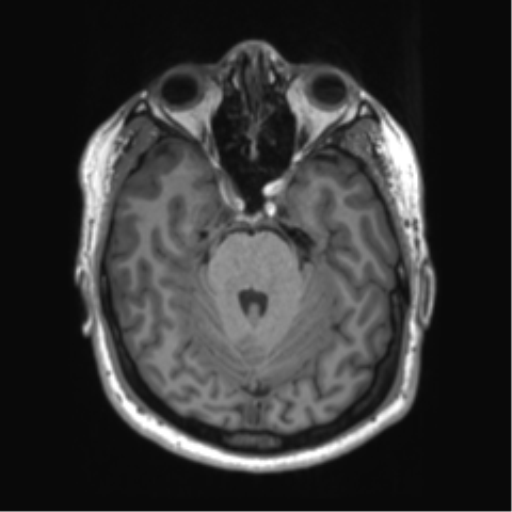 File:Achondroplasia (Radiopaedia 65109-74105 Axial T1 39).png