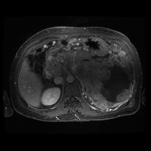 Acinar cell carcinoma of the pancreas (Radiopaedia 75442-86668 Axial T1 C+ fat sat 68).jpg
