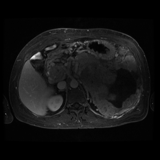 Acinar cell carcinoma of the pancreas (Radiopaedia 75442-86668 D 71).jpg