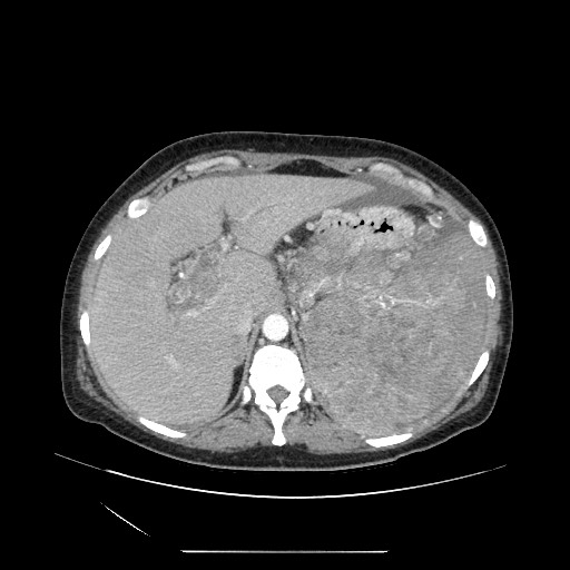 Acinar cell carcinoma of the pancreas (Radiopaedia 75442-86669 Axial C+ portal venous phase 31).jpg