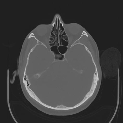 File:Acoustic schwannoma (Radiopaedia 29488-29982 AXIAL BONE THICK non-contrast 16).jpg