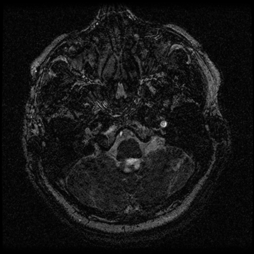 File:Acoustic schwannoma (Radiopaedia 33045-34060 Axial T2 3).png