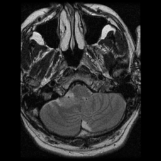 File:Acoustic schwannoma (Radiopaedia 39170-41387 Axial T2 4).png
