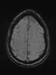 File:Acoustic schwannoma (Radiopaedia 55729-62281 Axial SWI 42).png