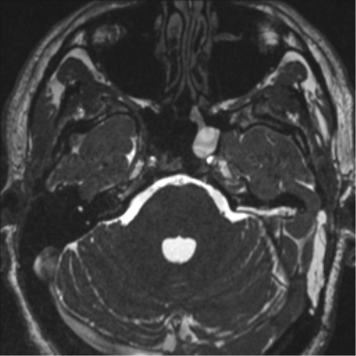 Acoustic schwannoma (translabyrinthine resection) (Radiopaedia 43570-46972 Axial CISS 34).png