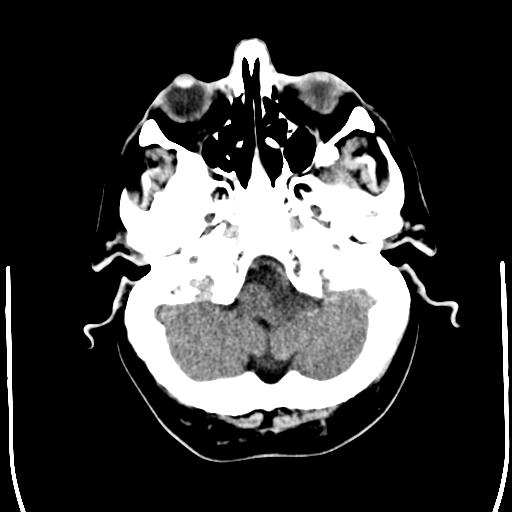 File:Acoustic schwannoma - cystic (Radiopaedia 29487-29980 AXIAL THICK non-contrast 4).jpg
