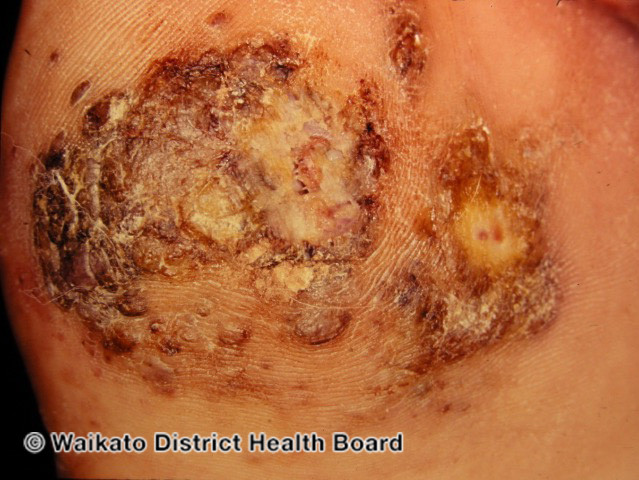 File:Acral lentiginous melanoma (DermNet NZ lesions-w-alm2).jpg