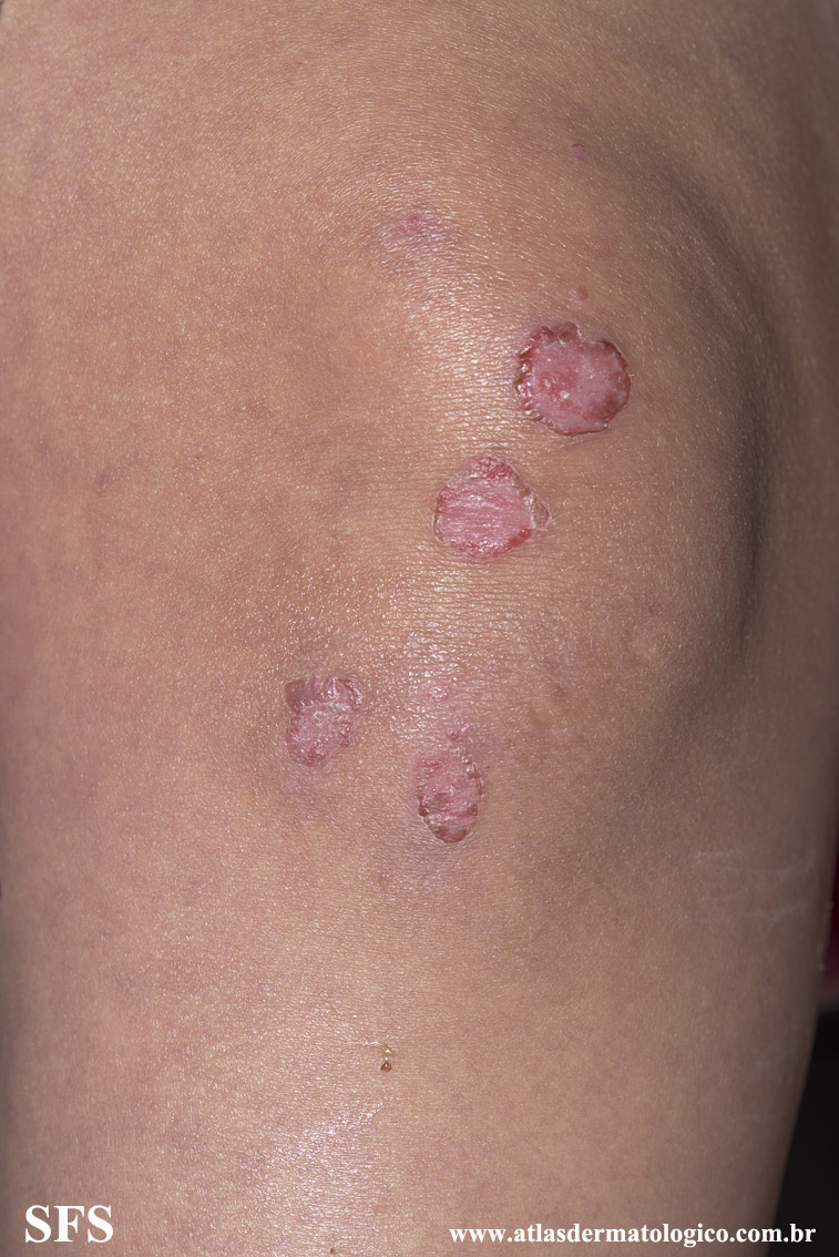 Acrodermatitis Enteropathica (Dermatology Atlas 49).jpg