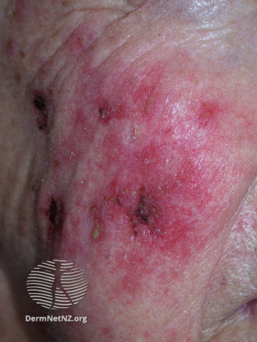 File:Actinic Keratoses treated with imiquimod (DermNet NZ lesions-ak-imiquimod-3769).jpg