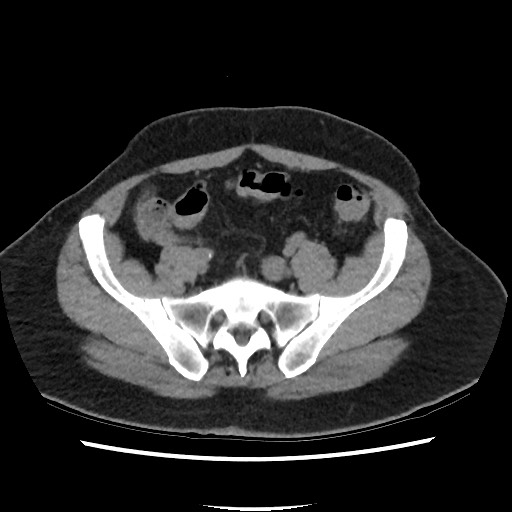 Active colonic bleed on CT (Radiopaedia 49765-55025 Axial non-contrast 62).jpg