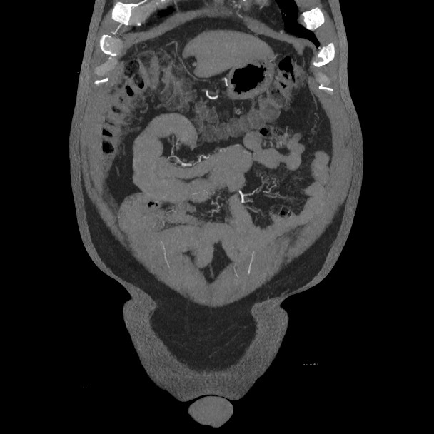 Active colonic bleed on CT (Radiopaedia 49765-55025 Coronal art MIP 16).jpg