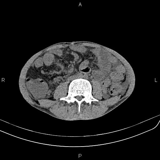Active crohn disease (Radiopaedia 87133-103397 Axial non-contrast 58).jpg