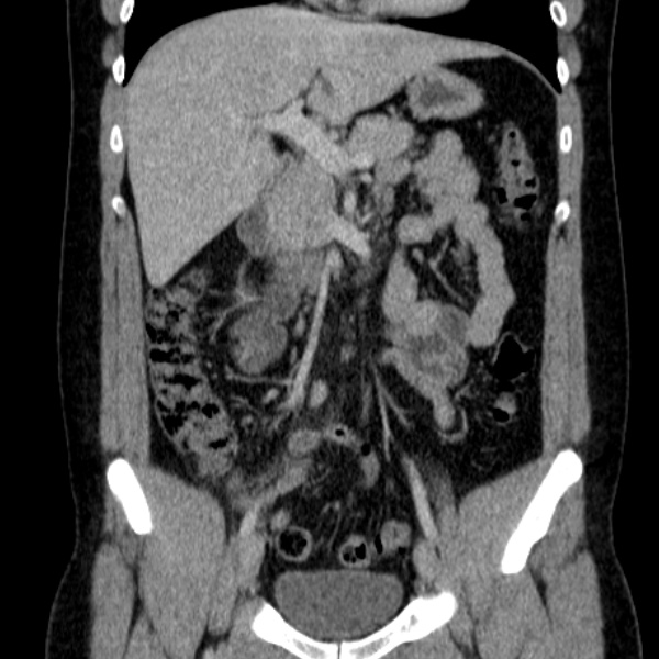 Acute appendicitis (Radiopaedia 38255-40270 Coronal C+ portal venous phase 39).jpg