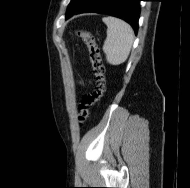 Acute appendicitis (Radiopaedia 38255-40270 Sagittal C+ portal venous phase 70).jpg