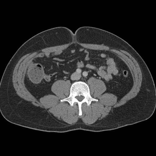 Acute appendicitis (Radiopaedia 48511-53463 Axial C+ portal venous phase 61).jpg