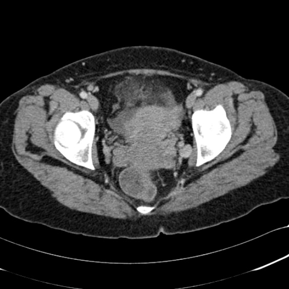 Acute appendicitis (Radiopaedia 48792-53822 Axial C+ portal venous phase 108).jpg