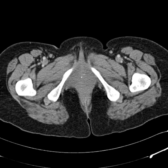 Acute appendicitis (Radiopaedia 48792-53822 Axial C+ portal venous phase 129).jpg